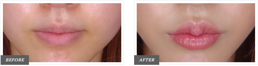 ヒアルロン酸注射による唇の整形例の画像(東京中央美容外科より引用)