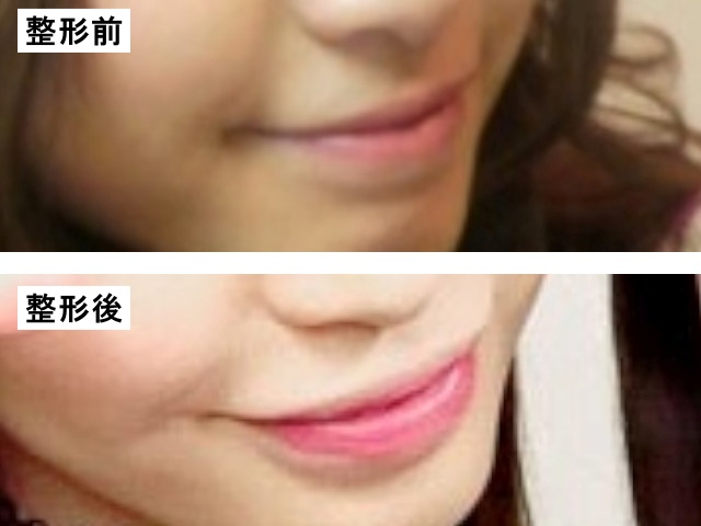 大島麻衣の唇の整形前と整形後の比較の画像