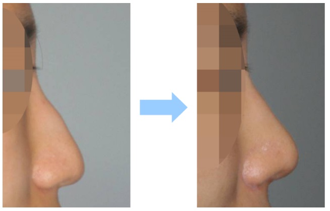 鷲鼻手術による鼻の整形例の画像(東京美容外科HPより引用)