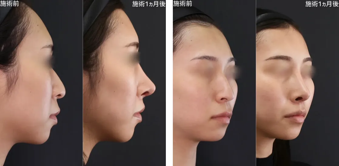 鼻プロテーゼによる鼻の整形例(TAクリニックグループHPより引用)