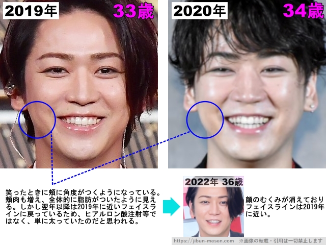 笑ったときに頬に角度がつくようになっている。頬肉も増え、全体的に脂肪がついたように見える。しかし翌年以降は2019年に近いフェイスラインに戻っているため、ヒアルロン酸注射等ではなく、単に太っていたのだと思われる。2022年36歳 顔のむくみが消えておりフェイスラインは2019年に近い。