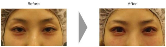 黒目整形による目の整形例の画像