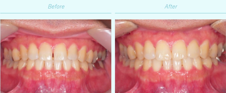 セラミック治療による歯の治療例の画像