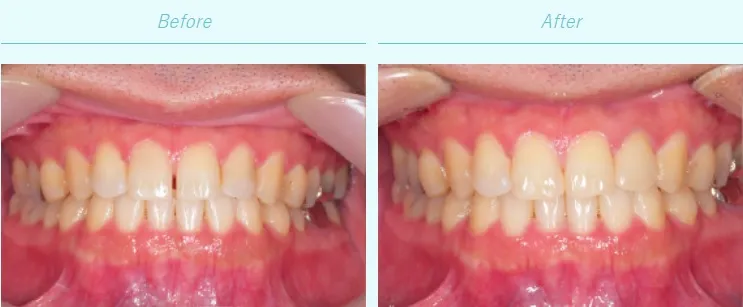 セラミック治療による歯の治療例(渋谷宮益坂歯科HPより引用)