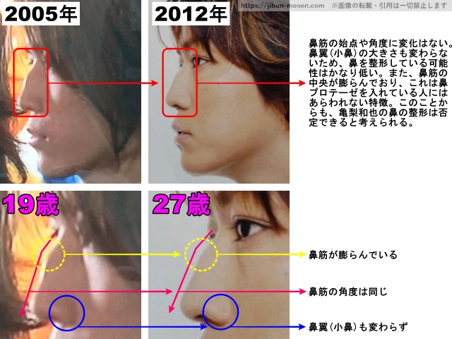 鼻筋の始点や角度に変化はない。鼻翼(小鼻)の大きさも変わらないため、鼻を整形している可能性はかなり低い。また、鼻筋の中央が膨らんでおり、これは鼻プロテーゼを入れている人にはあらわれない特徴。このことからも、亀梨和也の鼻の整形は否定できると考えられる。鼻筋が膨らんでいる。鼻筋の角度は同じ。鼻翼(小鼻)も変わらず。