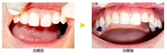 CR接着修復法の治療例(鍋山歯科クリニックHPより引用)