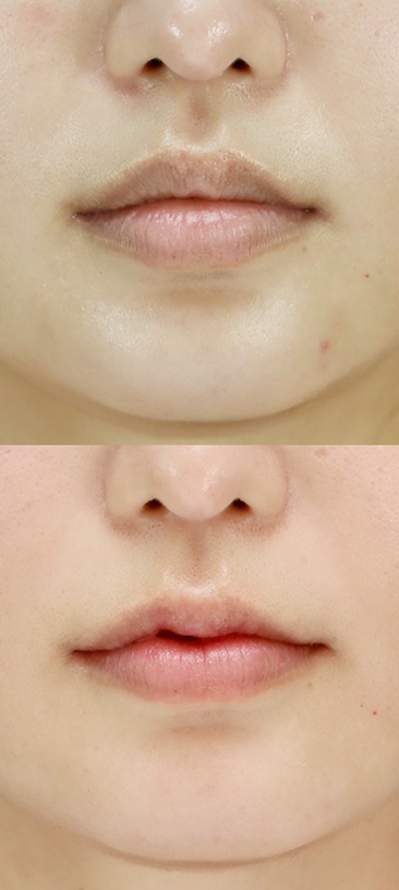 口唇縮小術による唇の整形例の画像