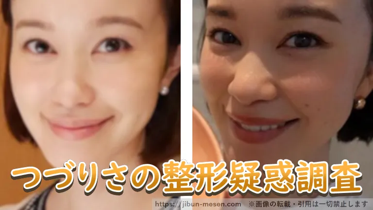 つづりさの整形疑惑調査