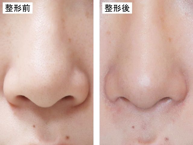 小鼻縮小による整形例の画像