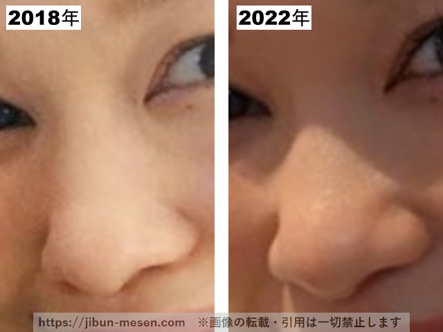 つづりさの鼻(正面)の整形疑惑調査2018-2022の画像