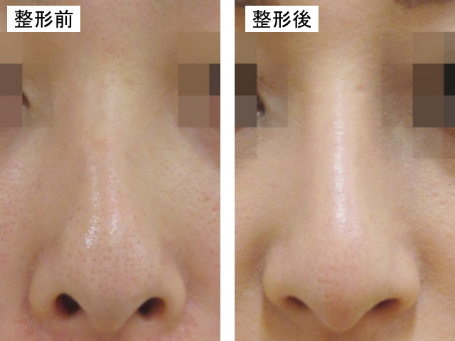 鼻プロテーゼによる整形例の画像