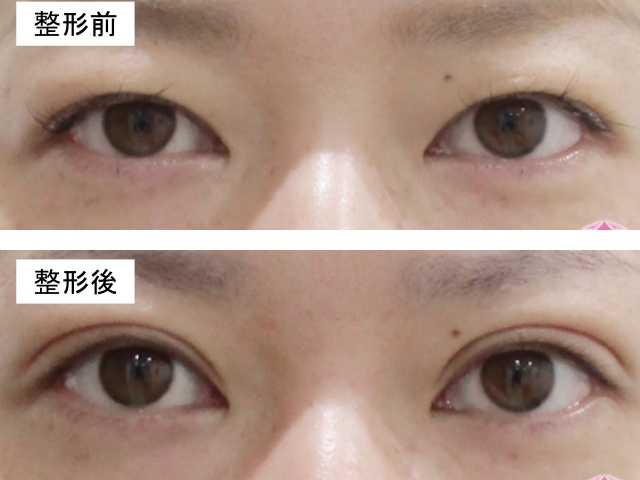 二重切開法による整形例の画像