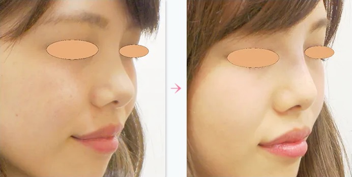 ヒアルロン酸注入による鼻の整形例の画像
