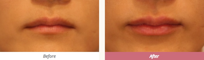 ヒアルロン酸注入による唇の整形例の画像