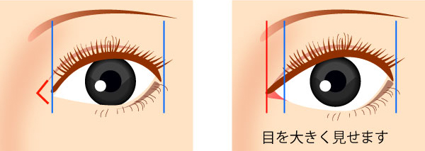 目頭切開法による整形例の画像