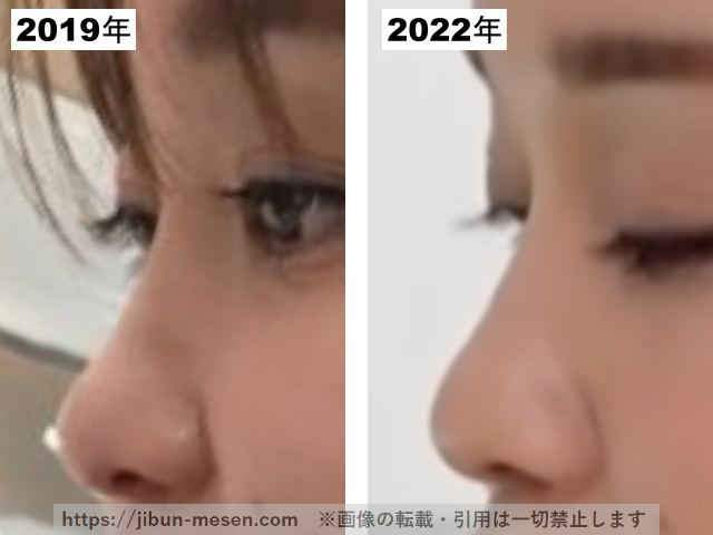 つづりさの鼻(横顔)の整形疑惑調査2019-2022の画像