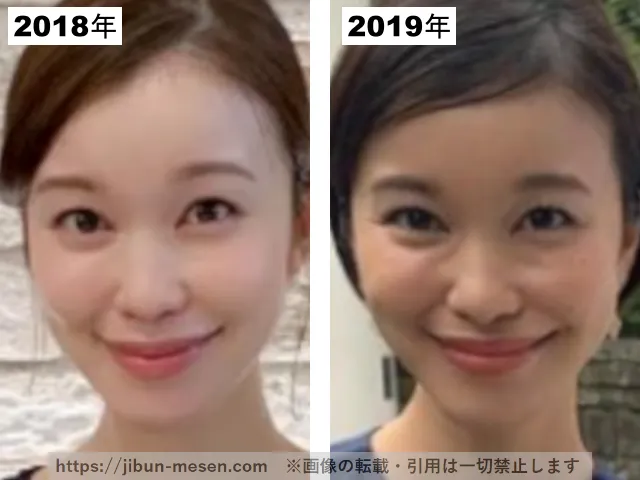 つづりさの整形疑惑調査2018-2019