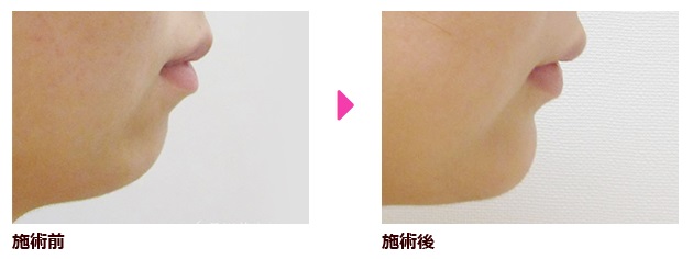 顎プロテーゼによる整形例の画像