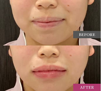 ヒアルロン酸注射の症例画像