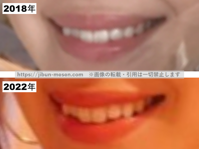 つづりさの唇(開口)の整形疑惑調査2018-2022の画像