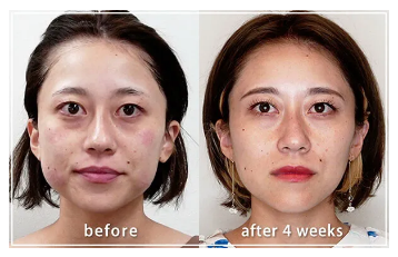 エラボトックスによる整形例の画像