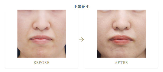 小鼻縮小による整形例の画像