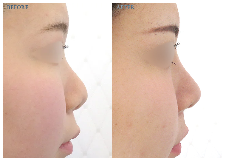 降鼻術(鼻プロテーゼ)による整形例の画像