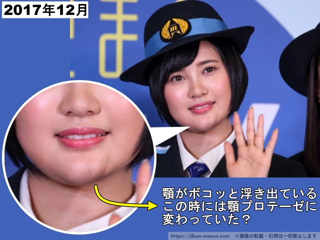 2017年12月顎がボコッと浮き出ている。この時には顎プロテーゼに変わっていた?