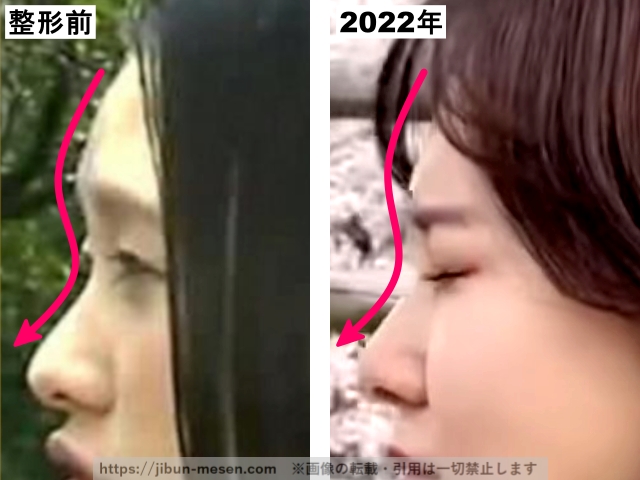 兒玉遥の鼻の整形前と2022年の比較(横顔)の画像
