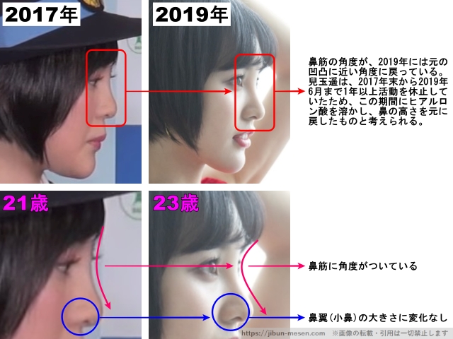 鼻筋の角度が、2019年には元の凹凸に近い角度に戻っている。兒玉遥は、2017年末から2019年6月まで1年以上活動を休止していたため、この期間にヒアルロン酸を溶かし、鼻の高さを元に戻したものと考えられる。鼻筋に角度がついている。 鼻翼(小鼻)の大きさに変化なし。