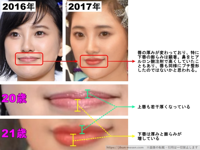 唇の厚みが変わっており、特に下唇の膨らみは顕著。鼻をヒアルロン酸注射で高くしていたこともあり、唇も同様にプチ整形したのではないかと思われる。上唇も若干厚くなっている。 下唇は厚みと膨らみが増している。