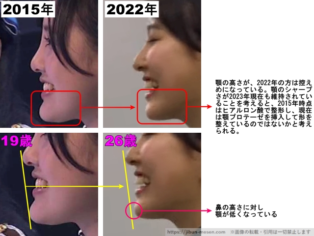 顎の高さが、2022年の方は控えめになっている。顎のシャープさが2023年現在も維持されていることも考えると、2015年時点はヒアルロン酸で整形し、現在は顎プロテーゼを挿入して形を整えているのではないかと考えられる。鼻の高さに対し顎が低くなっている。