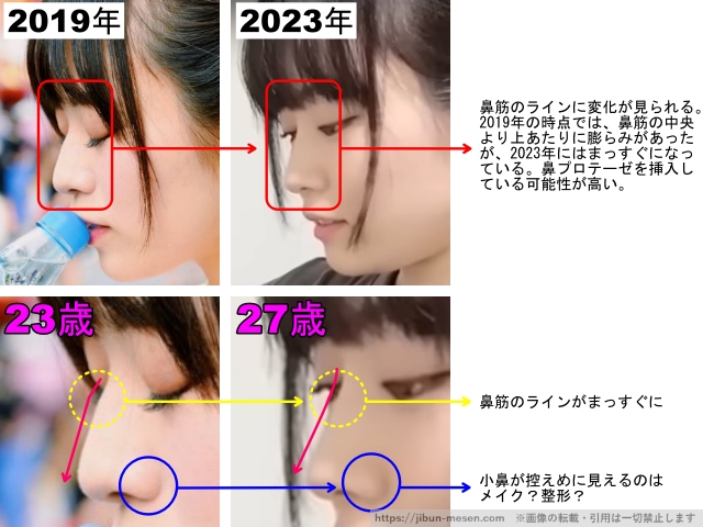鼻筋のラインに変化が見られる。2019年の時点では、鼻筋の中央より上あたりに膨らみがあったが、2023年にはまっすぐになっている。鼻プロテーゼを挿入している可能性が高い。鼻筋のラインがまっすぐに。
小鼻が控えめに見えるのはメイク？整形？