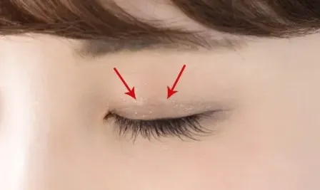 二重埋没法の施術跡(TAクリニックグループHPより引用)