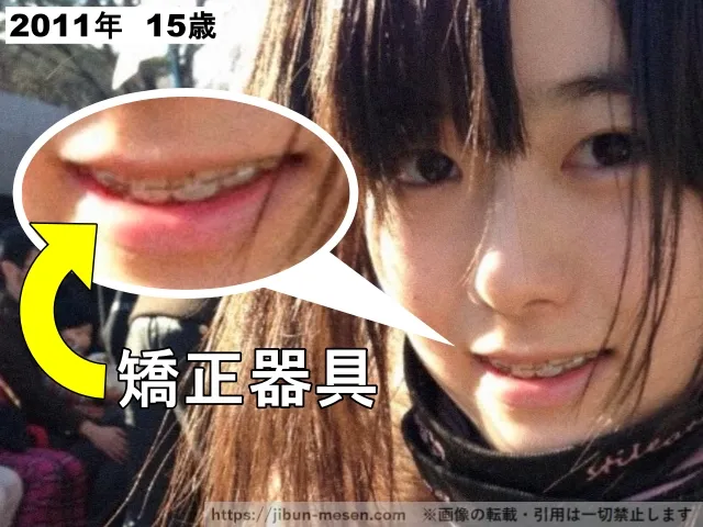 歯を矯正していた東雲うみ