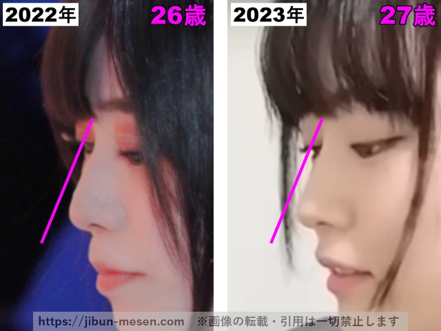 東雲うみの鼻筋の整形検証2022年〜2023年の画像