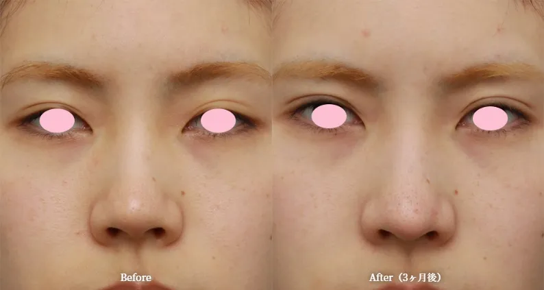 耳介軟骨移植による鼻の整形例(高須クリニックHPより引用)