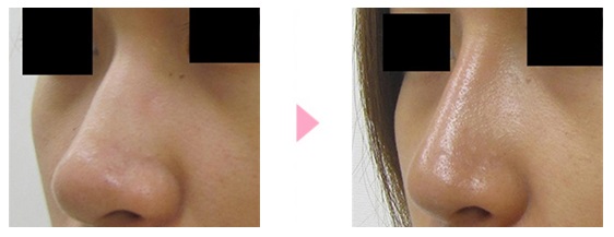 鼻プロテーゼによる鼻の整形例の画像