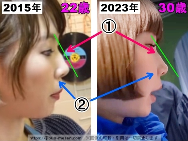 あさぎーにょの鼻の整形検証2015年～2023年(拡大)の画像