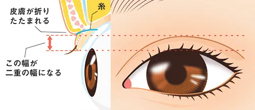 二重埋没法の仕組み(ヴィーナスビューティークリニックHPより引用)