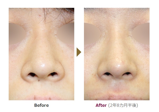 小鼻縮小による鼻の整形例の画像