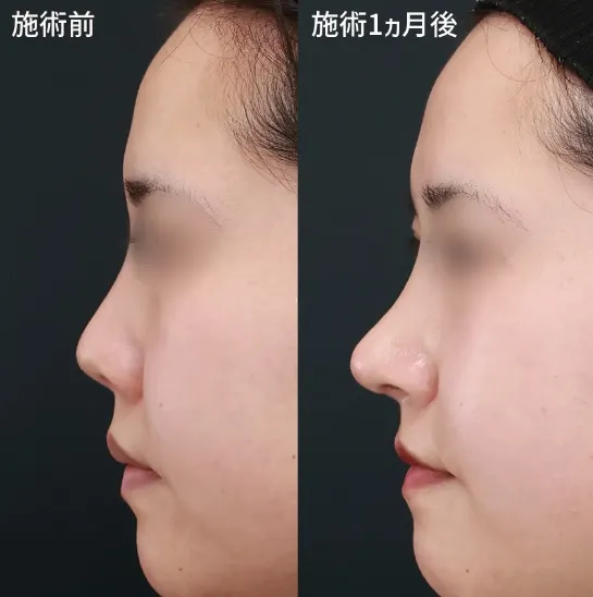 鼻中隔延長による鼻の整形例(TAクリニックグループHPより引用)