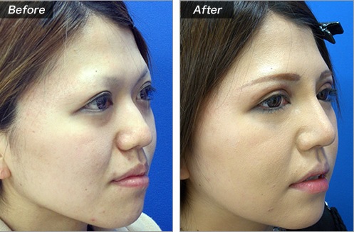 鼻プロテーゼによる鼻の整形例(城本クリニックHPより引用)