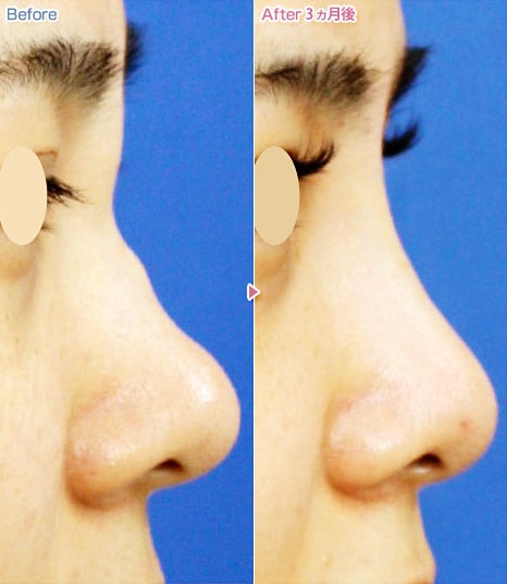 ヒアルロン酸注射による鼻の整形例(あつぎ美容クリニックHPより引用)