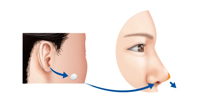 耳介軟骨飲食のイメージ図(高須クリニックHPより引用)