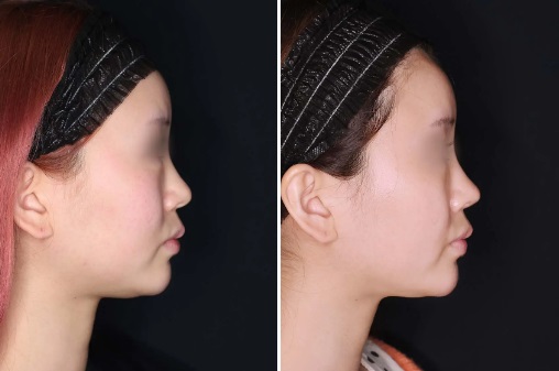 鼻尖縮小術による鼻の整形例(TAクリニックグループHPより引用)