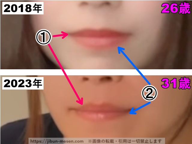 じゅえりーの唇の整形検証2018年〜2023年(拡大)の画像
