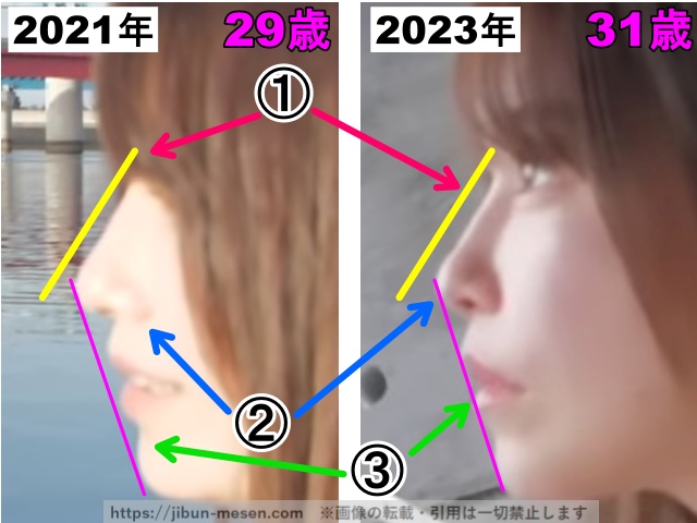 じゅえりーの鼻の整形検証2021年〜2023年(横顔・拡大)の画像