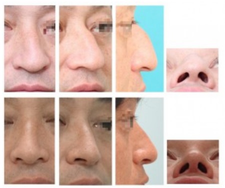 鼻中隔矯正術による鼻の整形例の画像