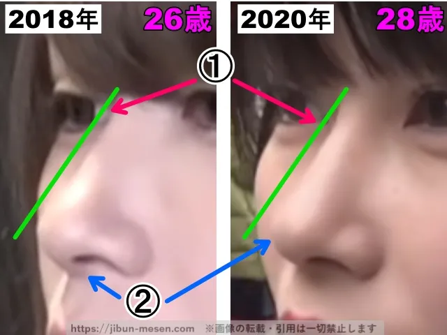 じゅえりーの鼻の整形検証2018年〜2020年(拡大・横顔)